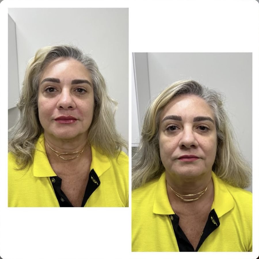 Resultado de preenchimento facial full face