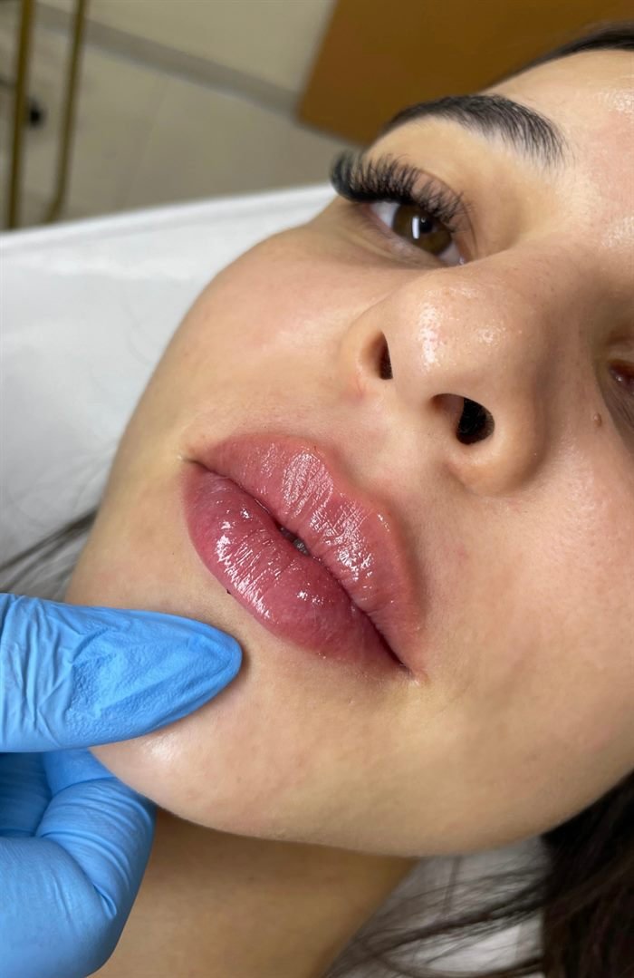 Resultado de preenchimento labial