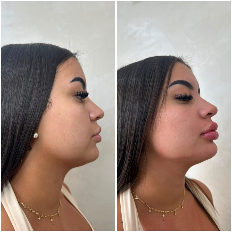 Resultado de perfiloplastia